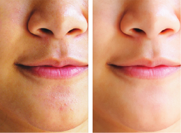 Skin brightening – before and after