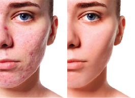Acne scarring – before and after