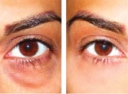Undereye dark circles – before and after