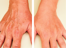 Stretch marks – before and after